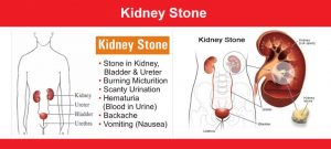 kidney stone 
