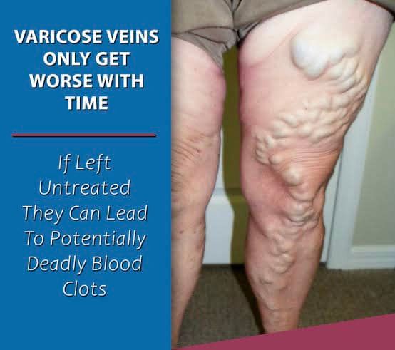 Varicose veins Treatment with Drpk Gyan 
1 Bulging veins: Twisted, swollen, rope-like veins are often
blue or purple. They appear just below the surface of the
skin on your legs
2 Heavy legs: Legs may feel tired and heavy after physical
activity.
3 Itching: The area around varicose veins may itch.
4 Pain: Legs may be painful, achy or sore, muscle cramps.
5 Swelling: Your legs, ankles and feet can swell and throb.
6 Skin discolorations and ulcers: 
Severe varicose veins can
cause venous ulcers (sores) on your skin.
#drpkgyan #drgyanhomoeo
Consult Us for Best Homeopathy Treatment for Your Well Being. Get Effective And Safe Homeopathy Treatment For All Age Groups. Book an appointment now #patna #hajipur 
Visit Our Clinic At Patna & Hajipur.
Book Appointment- 9472381825
Visit Our Website- www.drgyanhomoeo.com