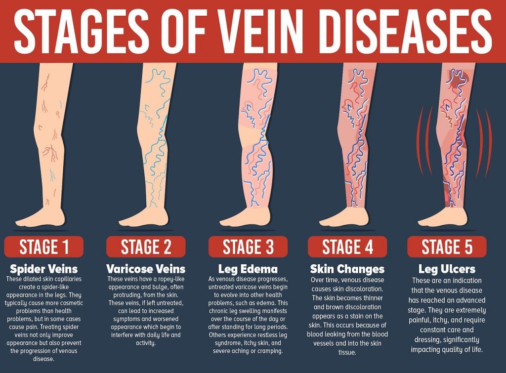 Varicose veins Treatment with Drpk Gyan in Patna