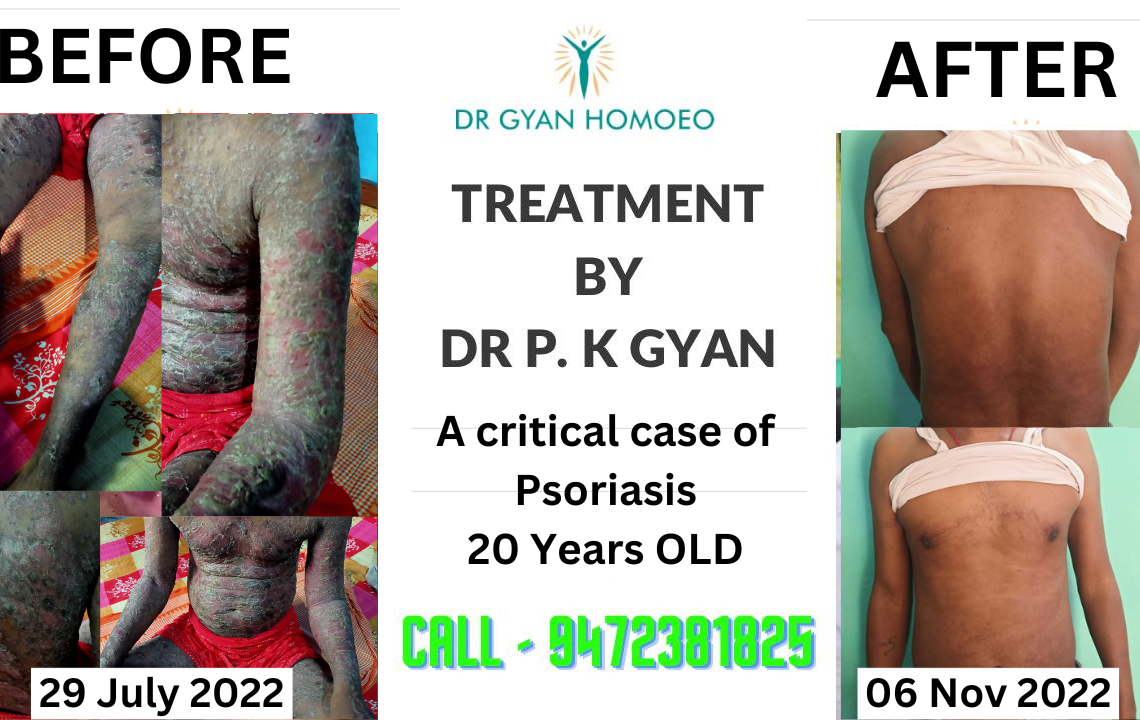 See Our Recent Patient Recovery Result, Patient Is Having critical case of Psoriasis since 20 Years